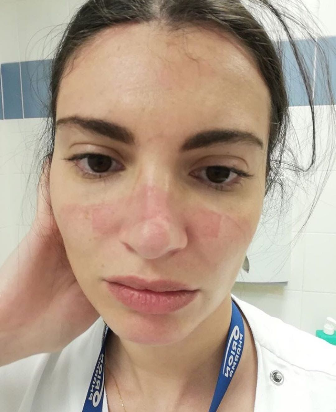 A young female nurse with a red wound on her nose caused by a face mask
