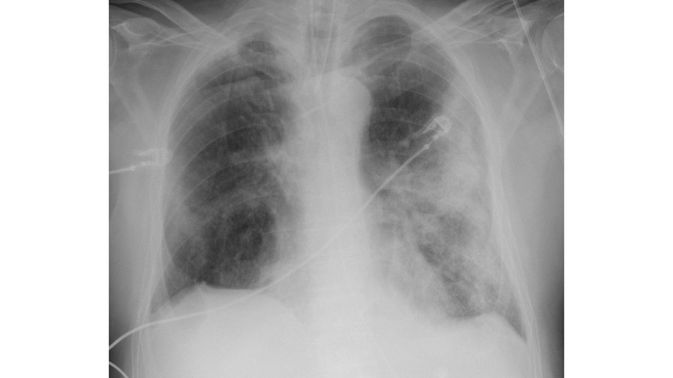 Snimak pluća 68-godišnjaka sa teškim oblikom Kovid-19. Beline na plućima su džepovi zahvaćeni upalom, zbog čega pacijent ima poteškoće sa disanjem