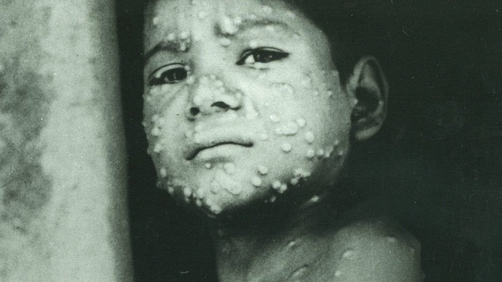 Historic picture of a child with measles